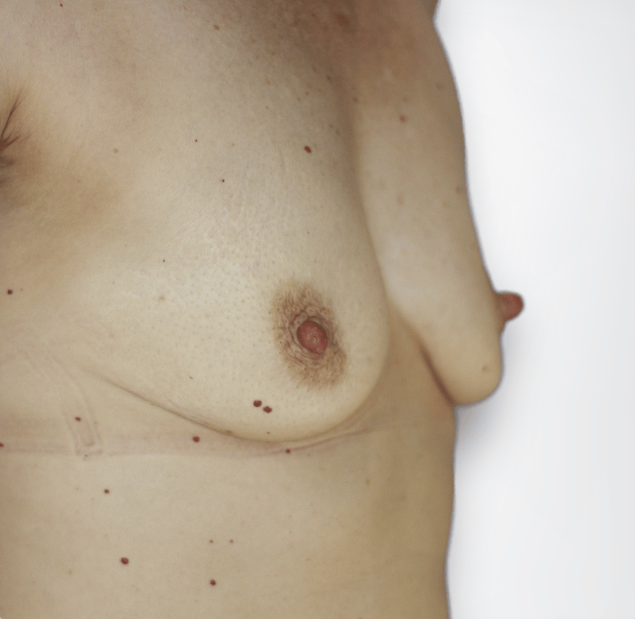 Powiększenie piersi implantami Maciej Charaziński
