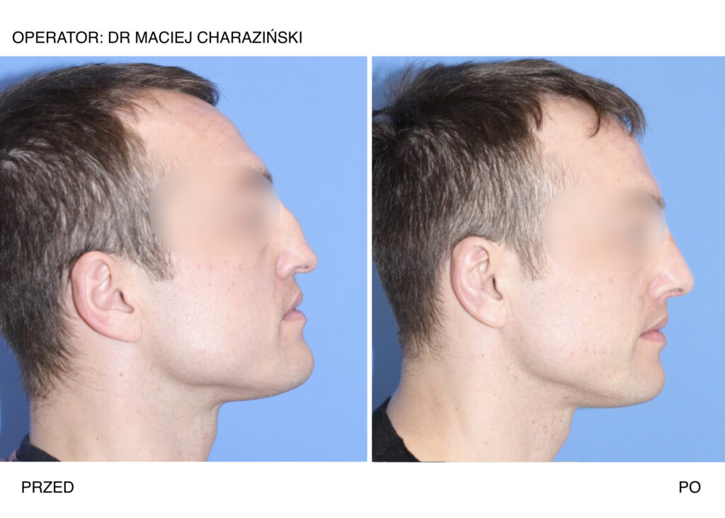 korekta-nosa-przed-i-po-dr-maciej-charaziński-klinikapromedion jpeg