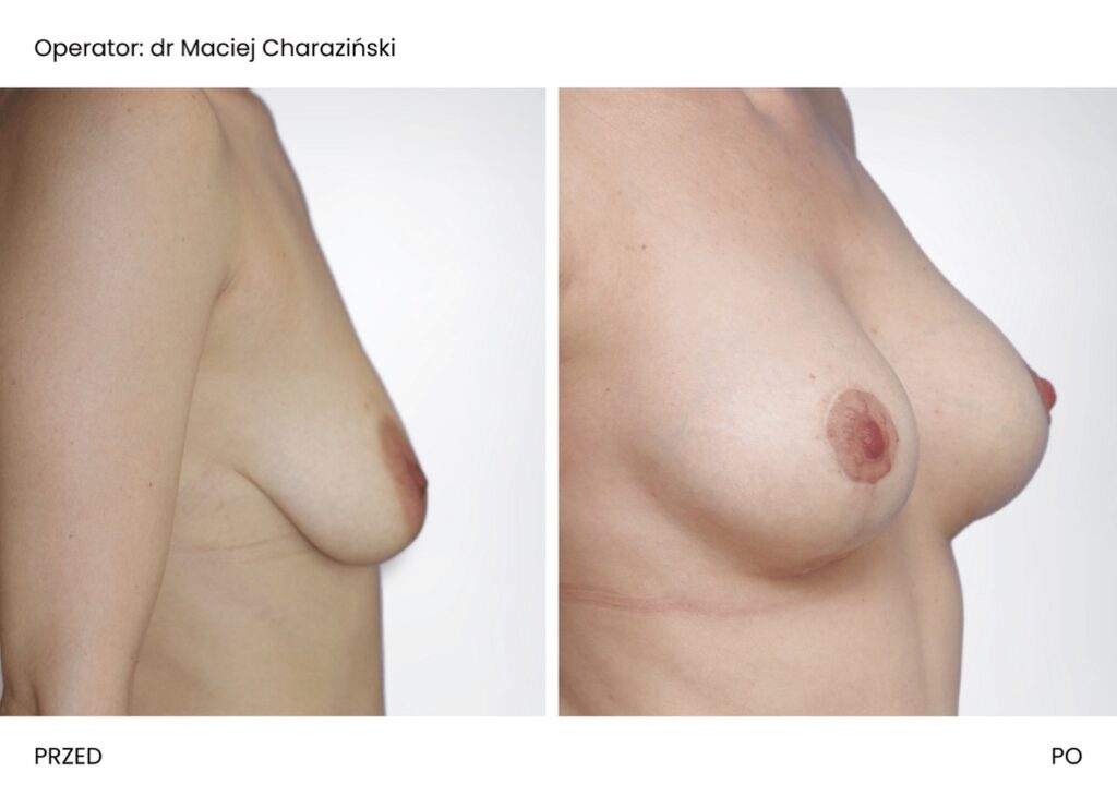 Powiększenie piersi implantami Maciej Charaziński